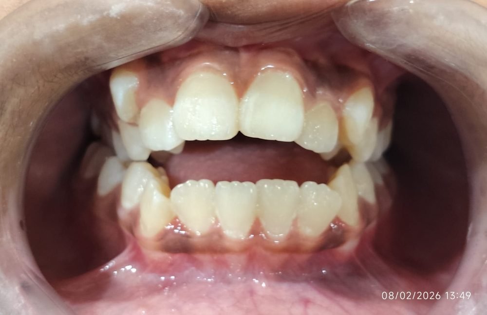 Clear aligner treatment at Nature's Dental Care, Lucknow